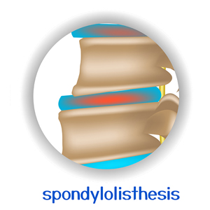 image of Carrolltown spondylolisthesis